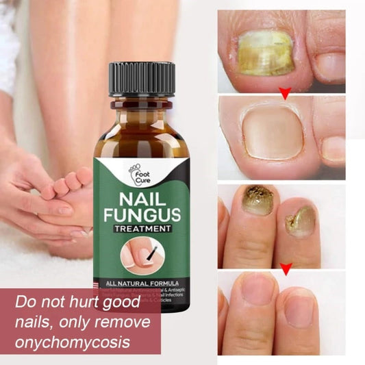 Fast Nail Fungal Treatment